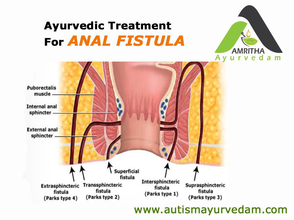 Ayurvedic Treatment For Anal Fistula! Ayurvedic Treatment For Anal Fistula!