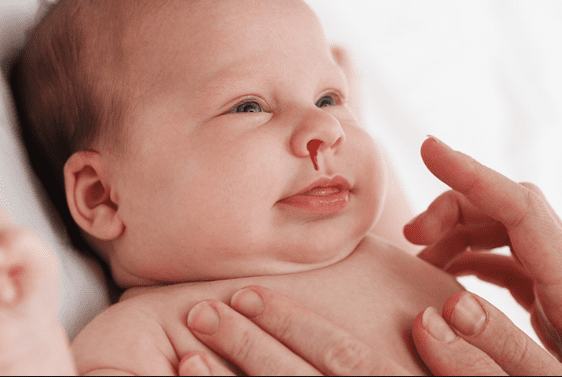 Effective Home Remedies For Nose Bleeding! Home Remedies For Nose Bleeding
